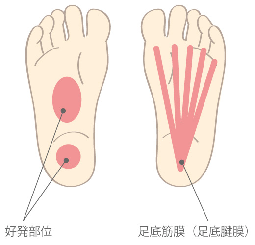 タカハラ整形外科クリニック 足底筋膜炎～足の裏の痛み～